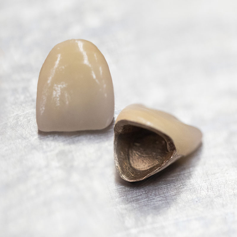 内側が金属のメタルボンドクラウン