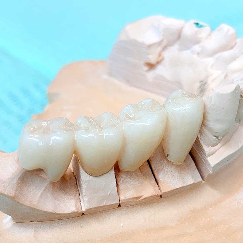 ジルコニアブリッジ