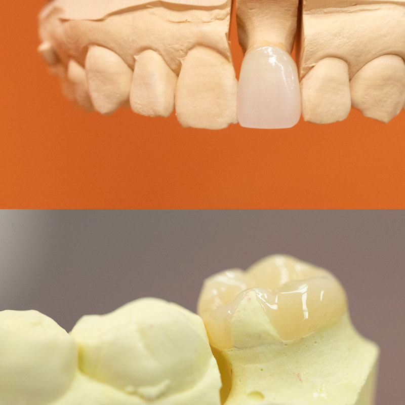 上:ジルコニアクラウン、下:ジルコニアインレー